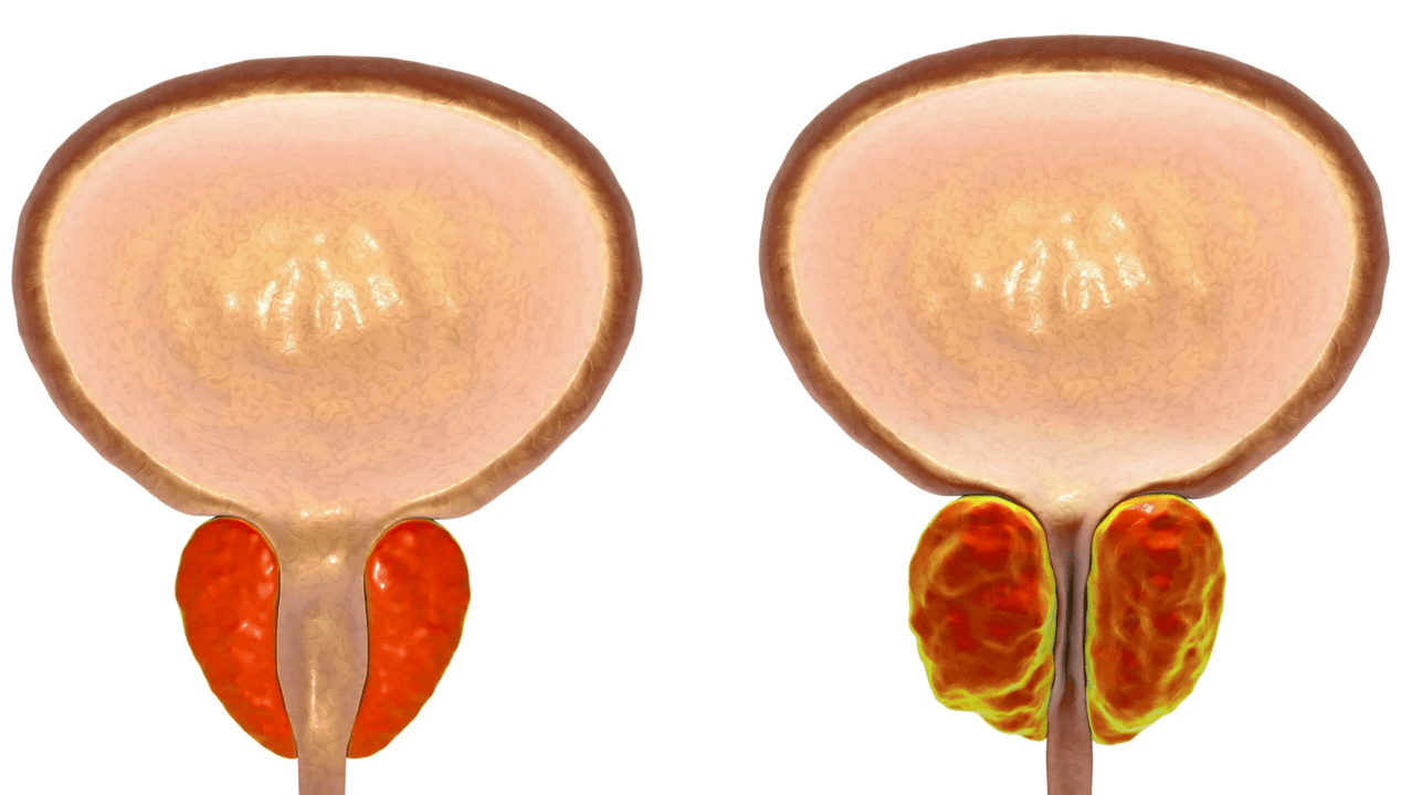 რა არის პროსტატიტი