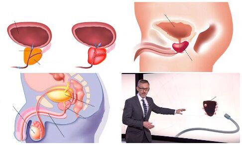 ჯანმრთელი და დაავადებული პროსტატი